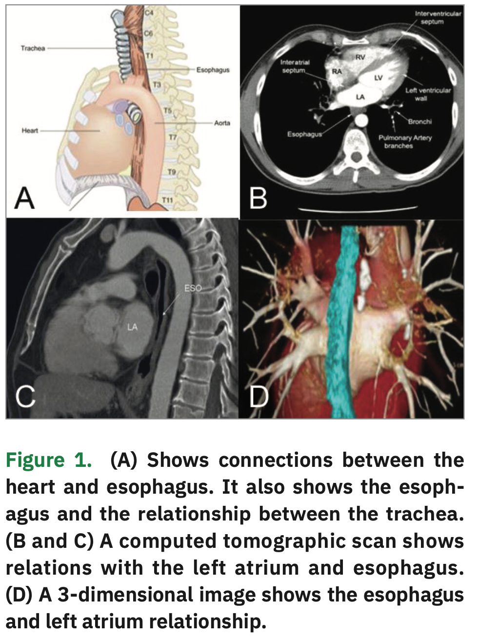 Mechanical Deviation of the Esophagus During Atrial Fibrillation